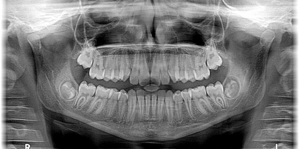 røntgenbilde hos tannlege eller tannpleier Nesodden Fagerstrand tannklinikk drøbak